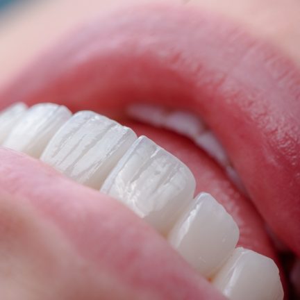 Natural,Looking,Ceramic,Veneers,With,A,Texture,And,Translucent,Edge